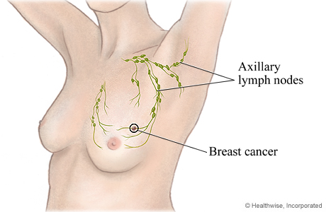 removing lymph nodes breast cancer Ceo fired sexual harassment seinfeld quote